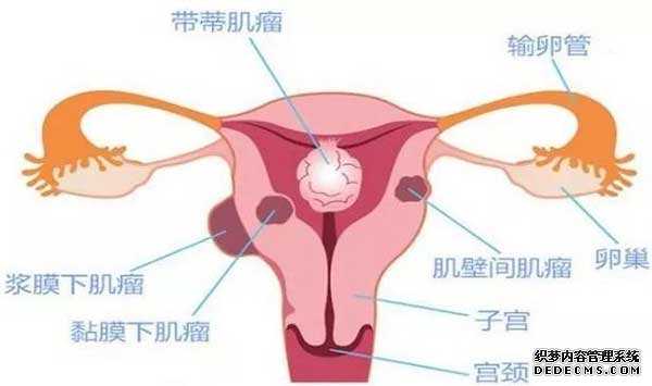 遂昌县捐卵李炼_子宫肌瘤患病率达25%，是否影响试管婴儿怀孕成功率？