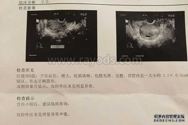 日本人捐卵子_试管婴儿今天一超孕囊太小8㎜没胎心正常吗